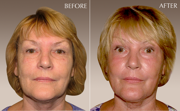 laser_resurfacing