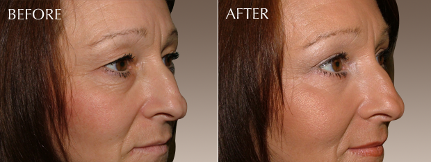 blepharoplasty