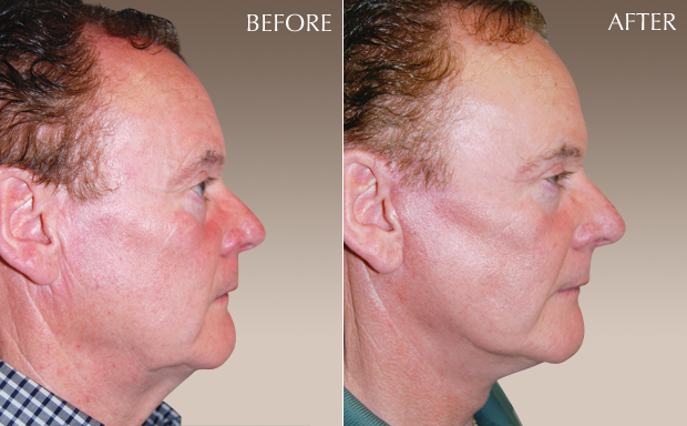 facelift caption