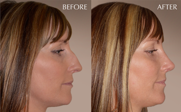 rhinoplasty_1