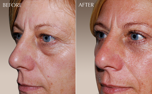 blepharoplasty3